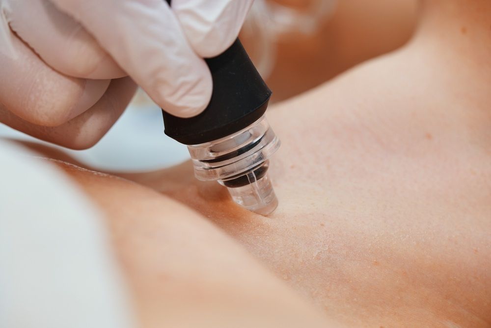 Close Up of a Person Getting a Treatment on Their Skin — Gladstone Beauty Clinic In Gladstone Central, QLD