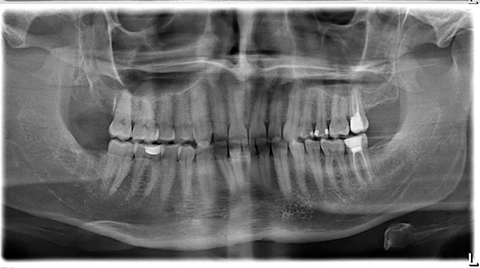 Radiography Image - Matthews, NC - Dr. Mark M. Petryna, DDS