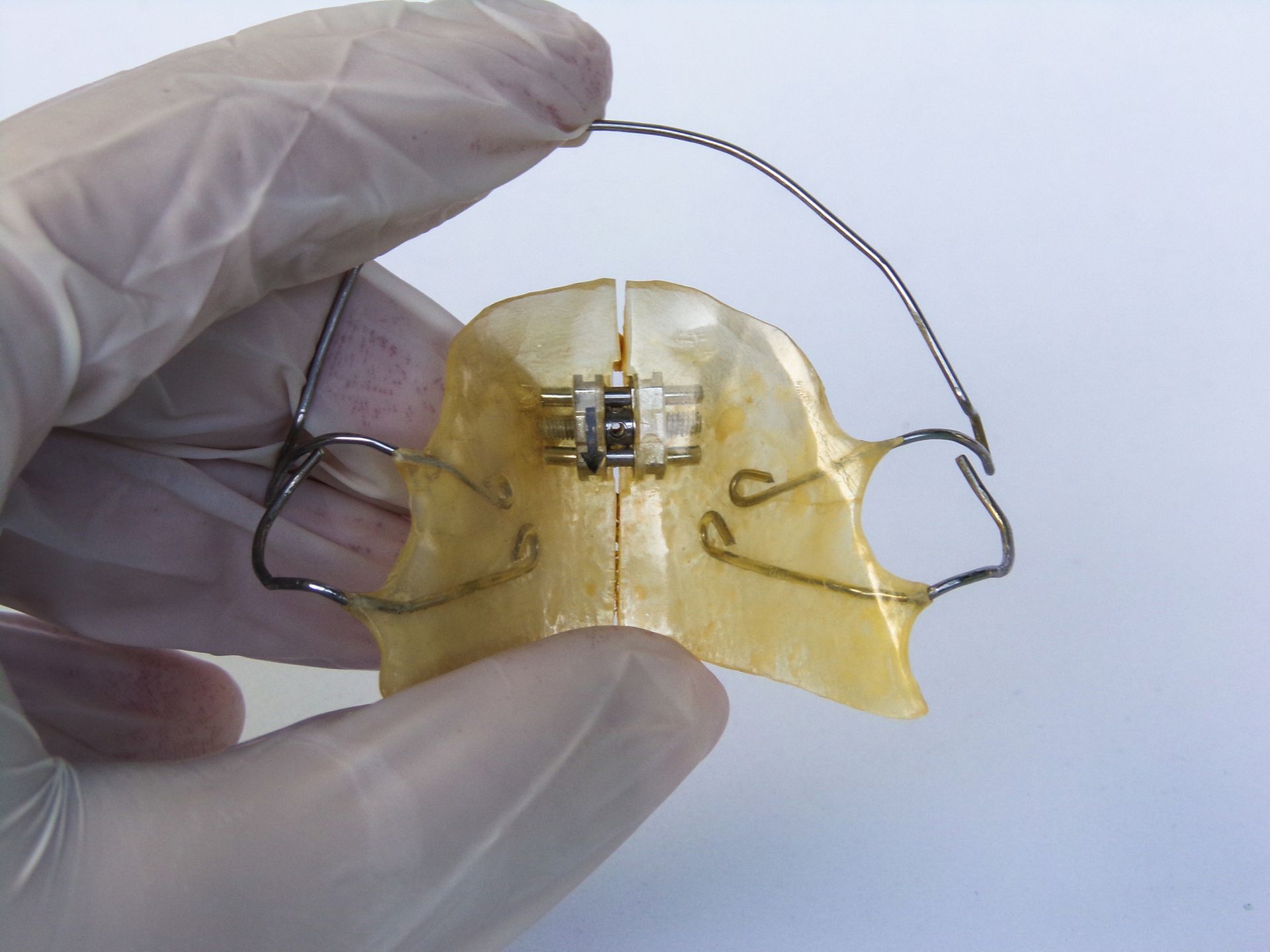 Hand holding a yellow dental palate expander device with a metal expansion screw and wire frame.