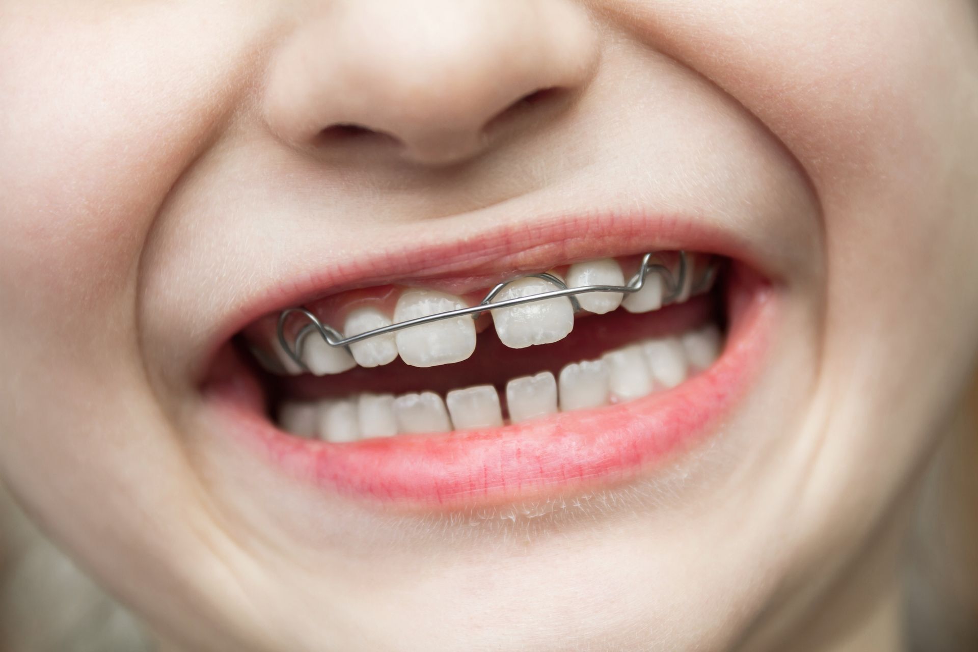 Close-up of a child's mouth, showing upper and lower teeth with orthodontic retainer.