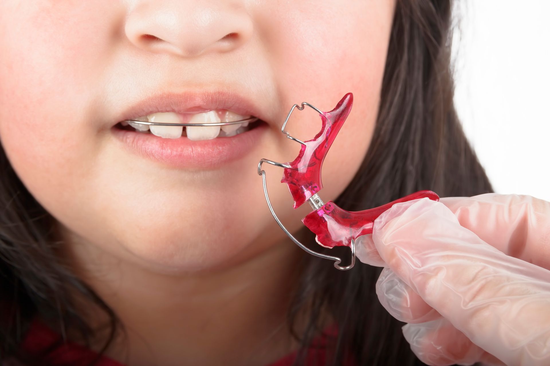 Child with braces about to insert a red retainer held by a gloved hand.