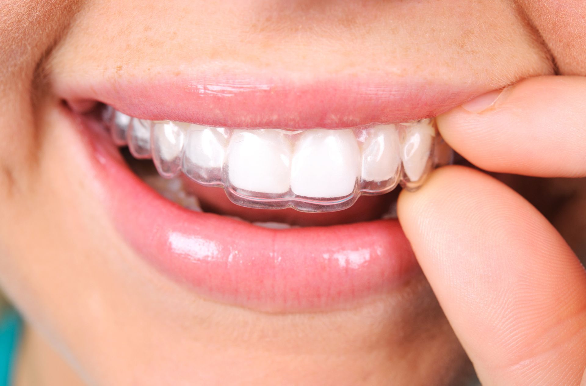 Person's mouth with clear aligners being adjusted on teeth. Close up, smiling.