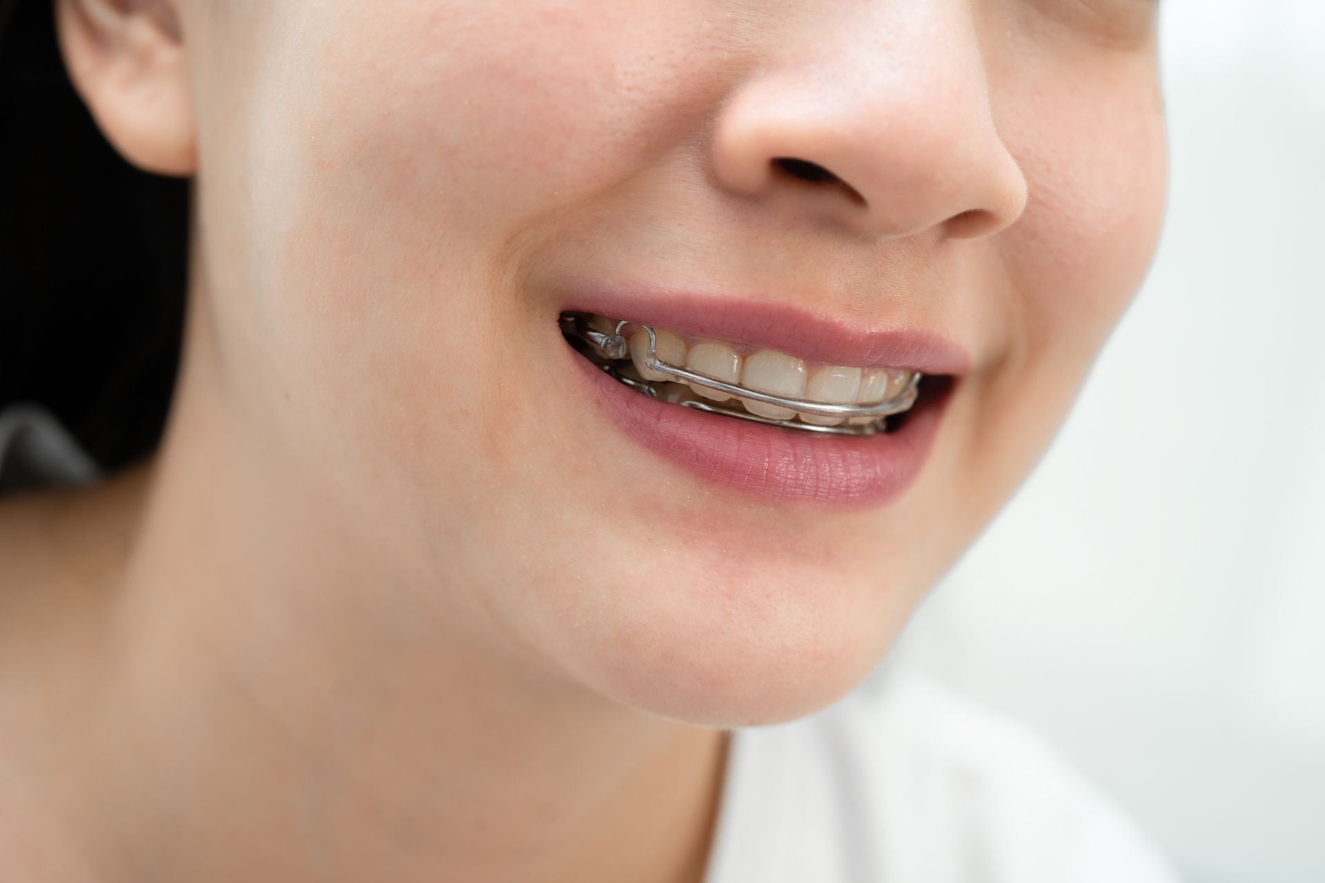 Close-up of a smiling person with clear braces on their teeth.