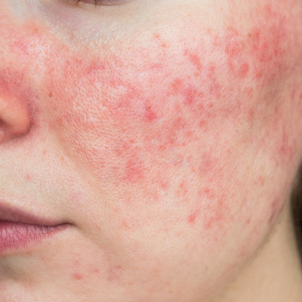 A close up of a woman 's face with Rosacea.