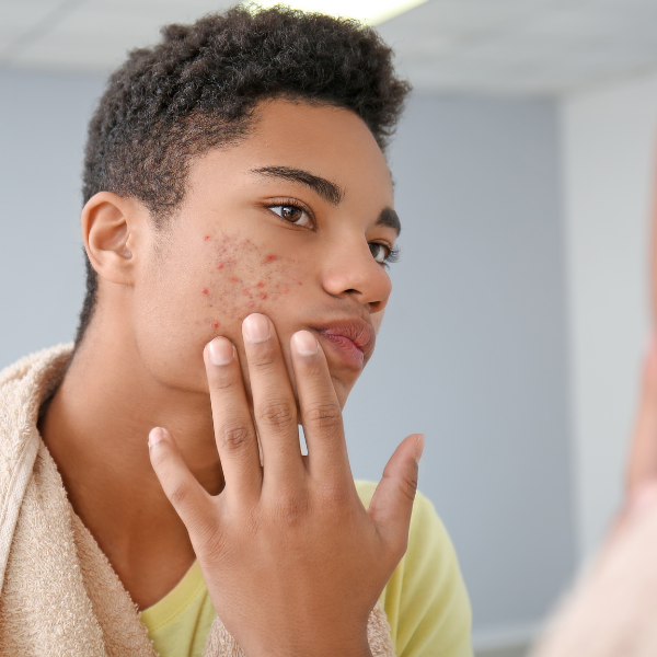 A young man with acne on his face looks at himself in the mirror / Sandstone Therapeutic Massage