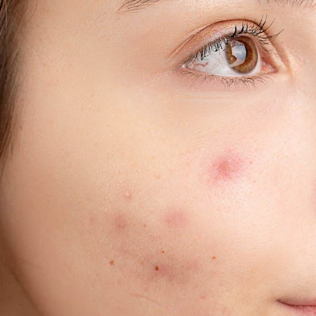 Sandstone Therapeutic Massage / A close up of a woman 's face with acne and a brown eye.