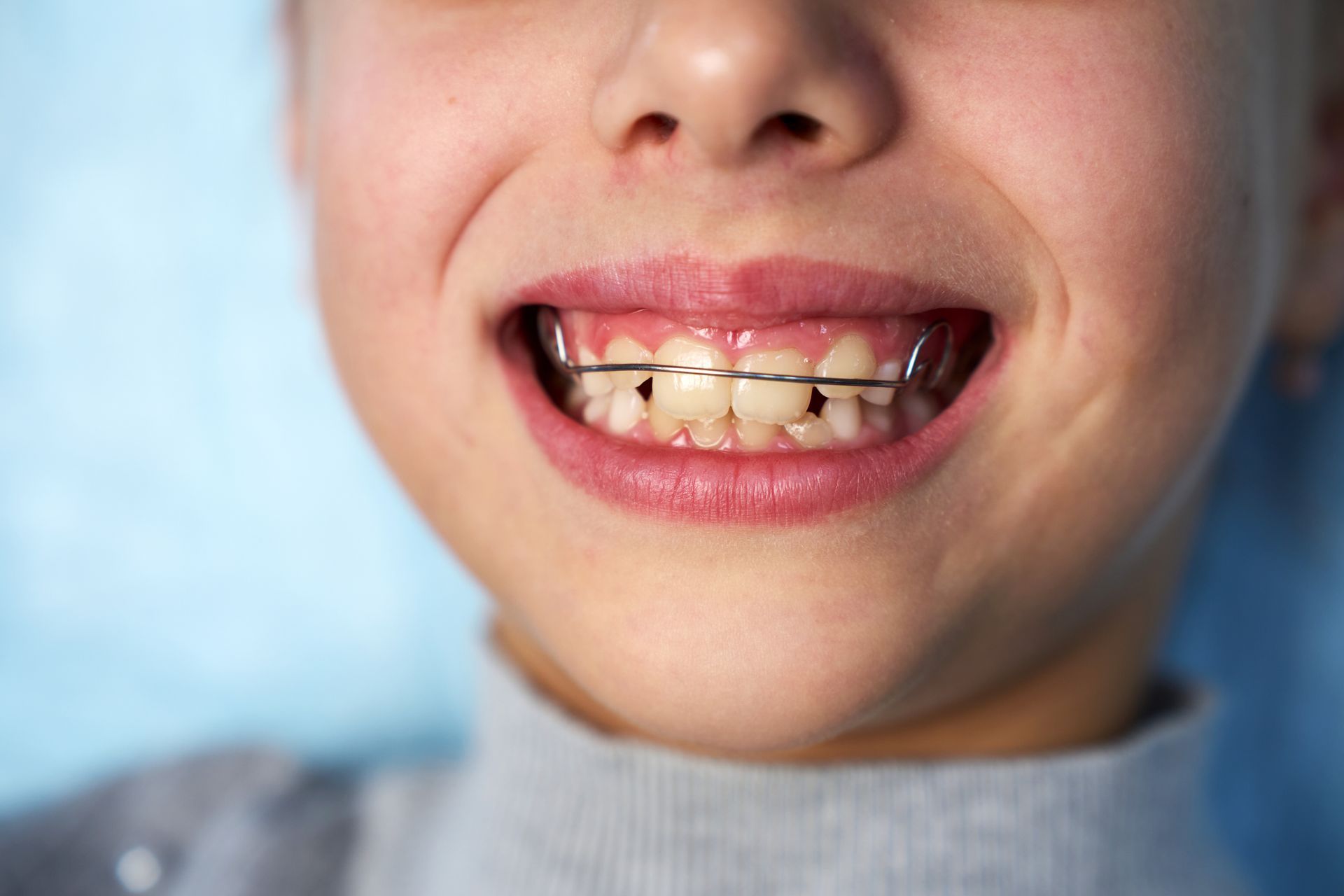 Ortopedia Facial dos Maxilares