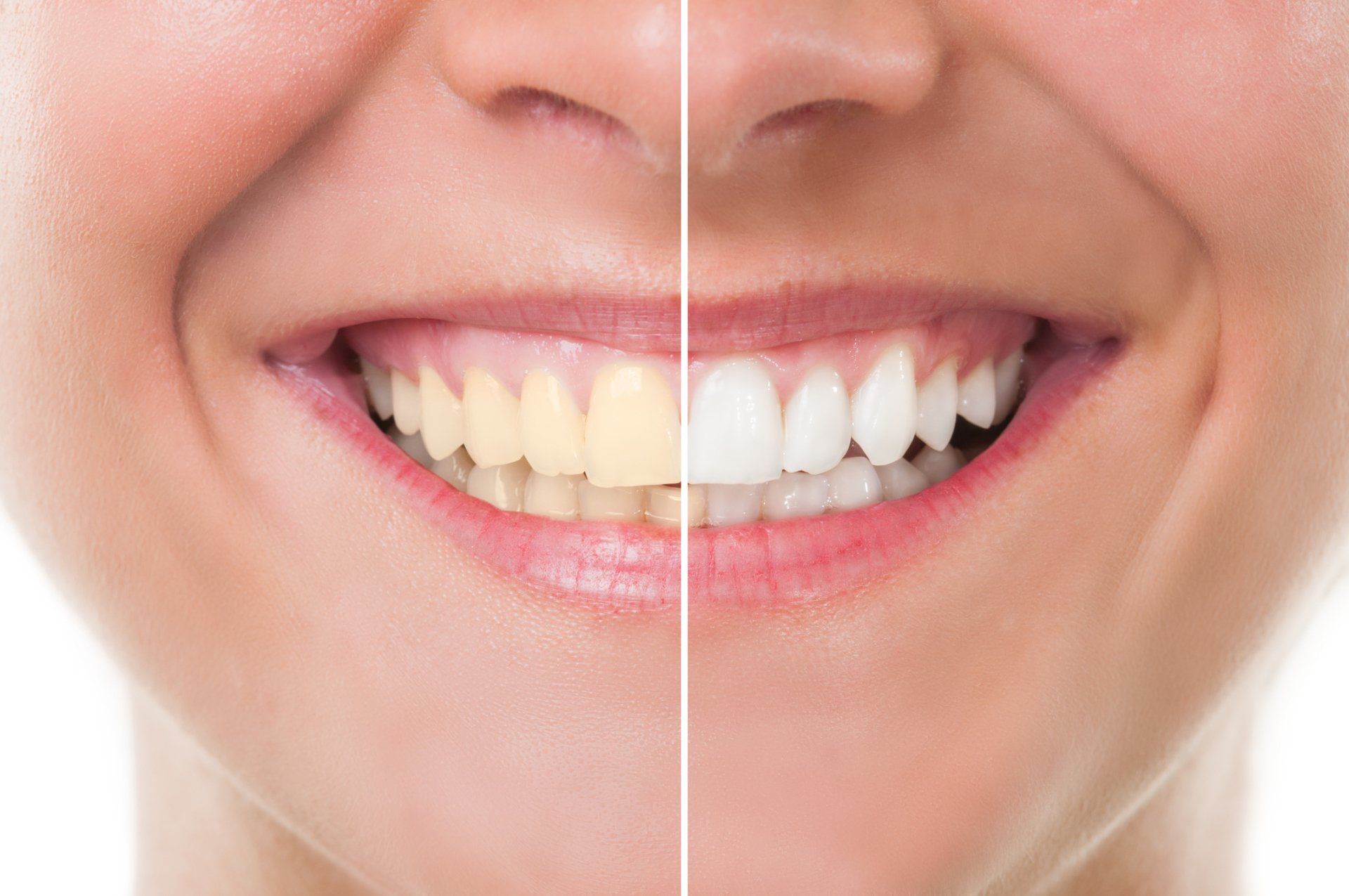 Teeth Whitening — Charlottesville, VA — William Grupp Dentistry