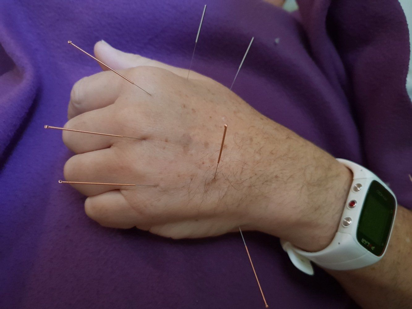 אדם עם מחטי דיקור בידו