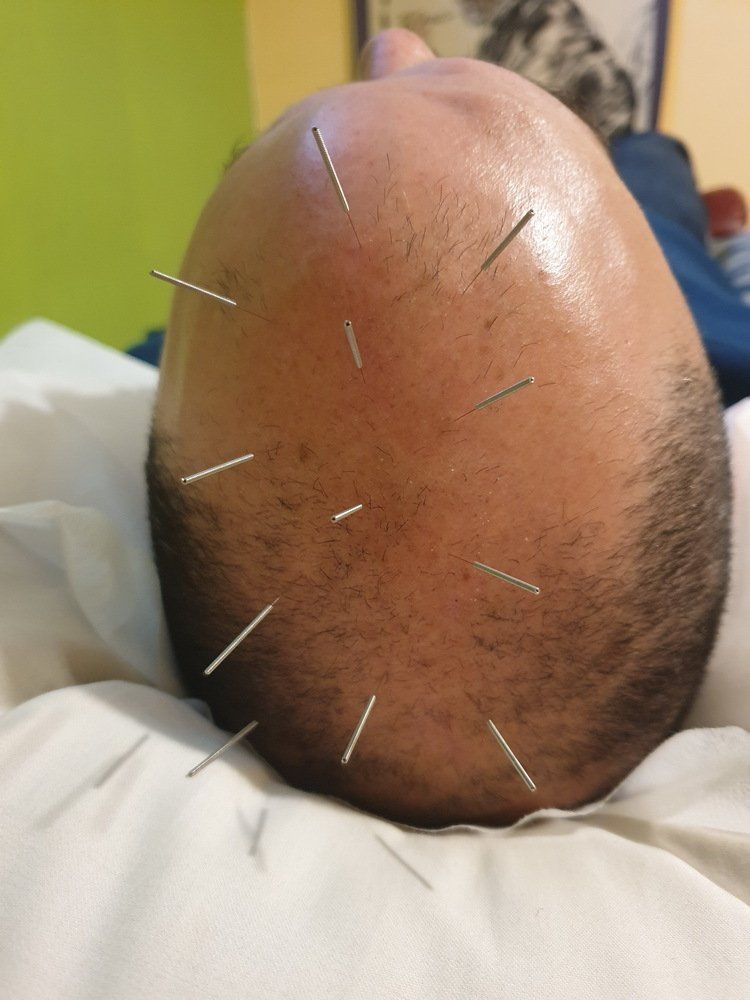 לגבר קירח יש חבורה של מחטים בראש