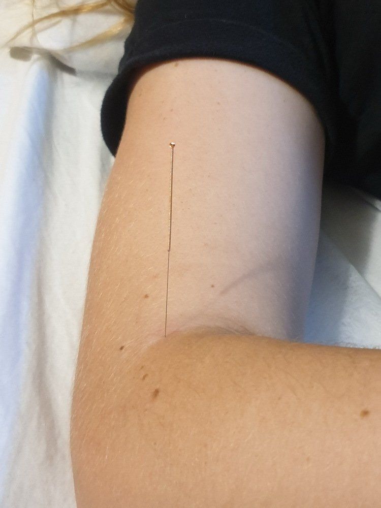 תקריב של זרועו של אדם עם מחט בתוכה