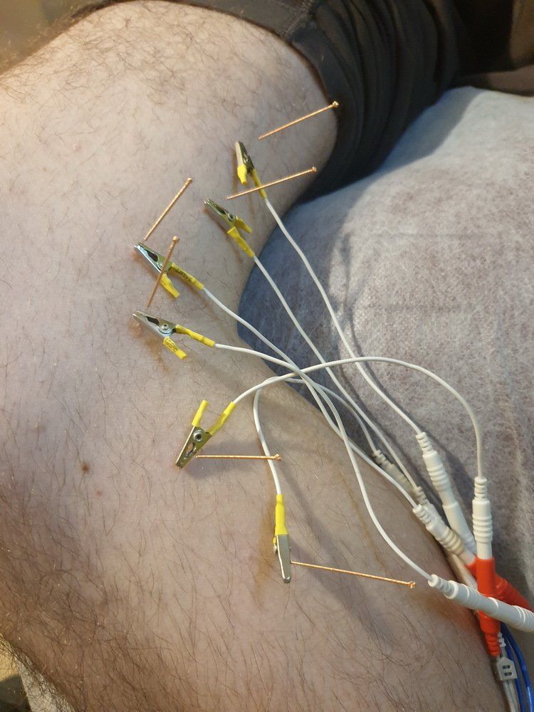 לאדם יש חבורה של חוטים מחוברים לרגל שלו