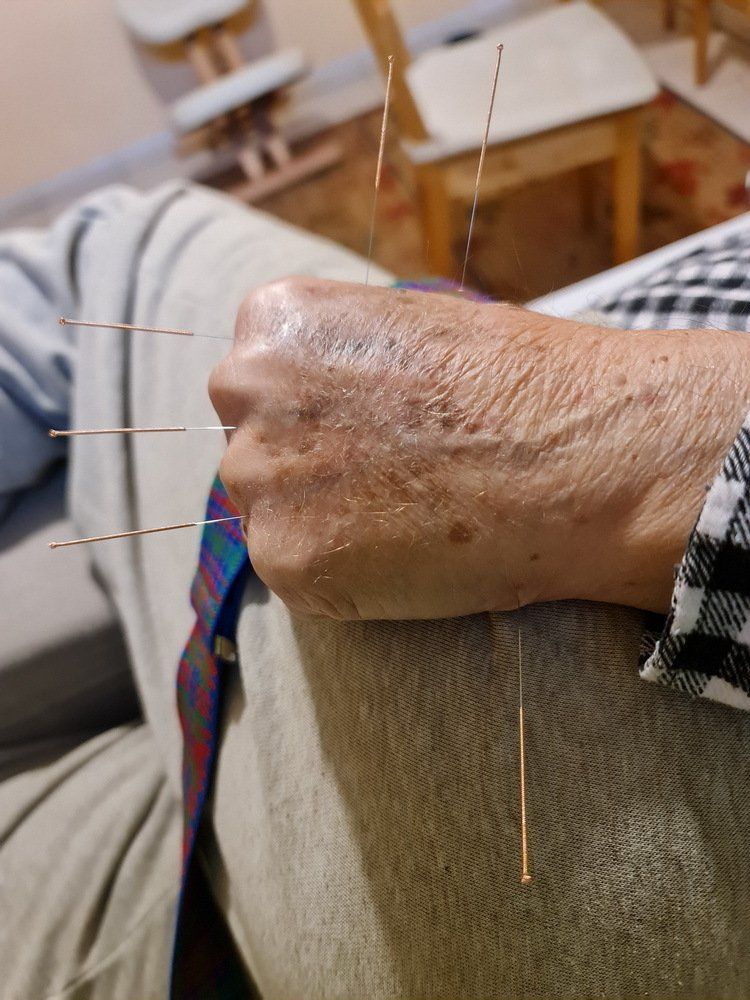 אדם מקבל דיקור סיני על פרק כף היד שלו.