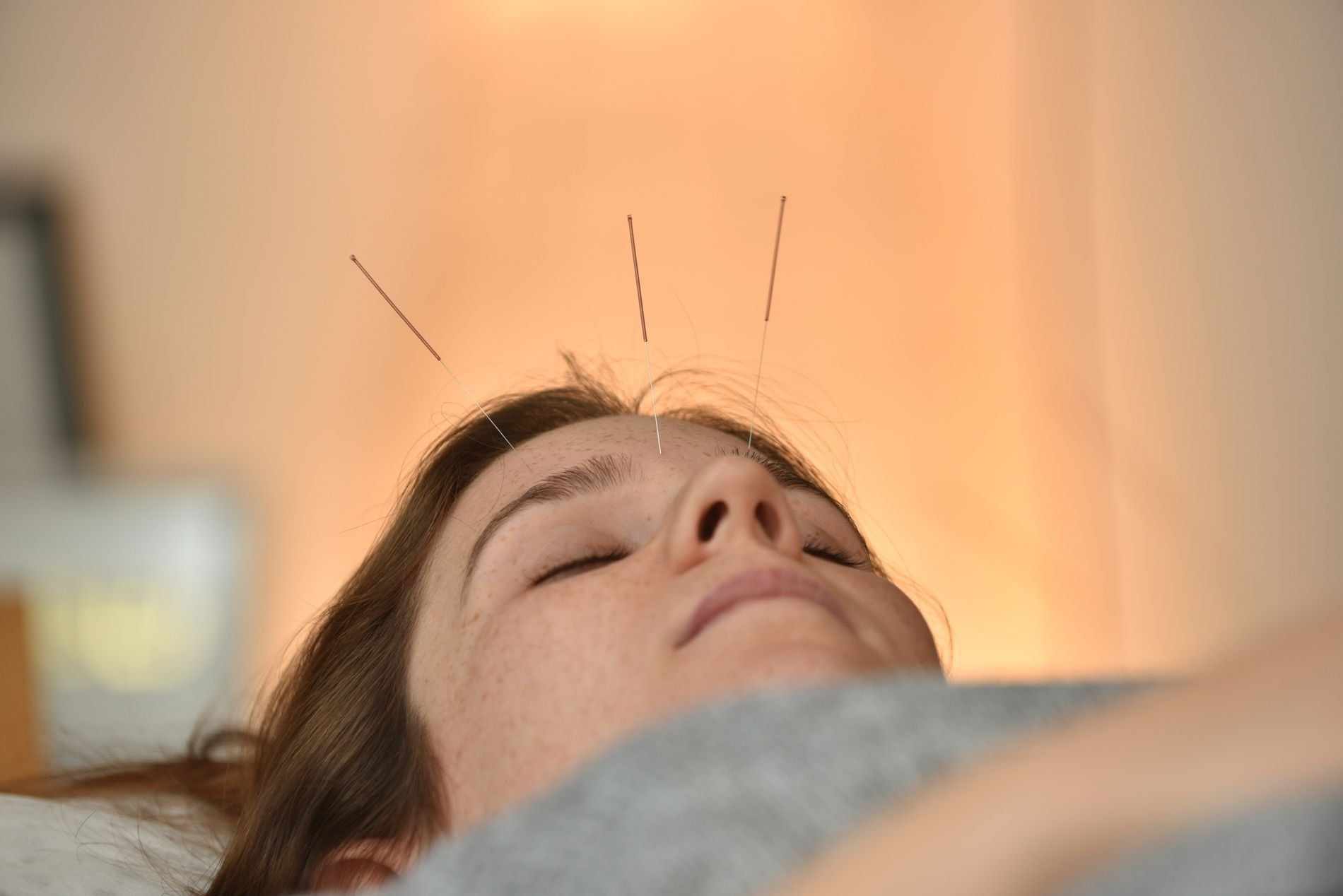 רפואה סינית - דיקור סיני