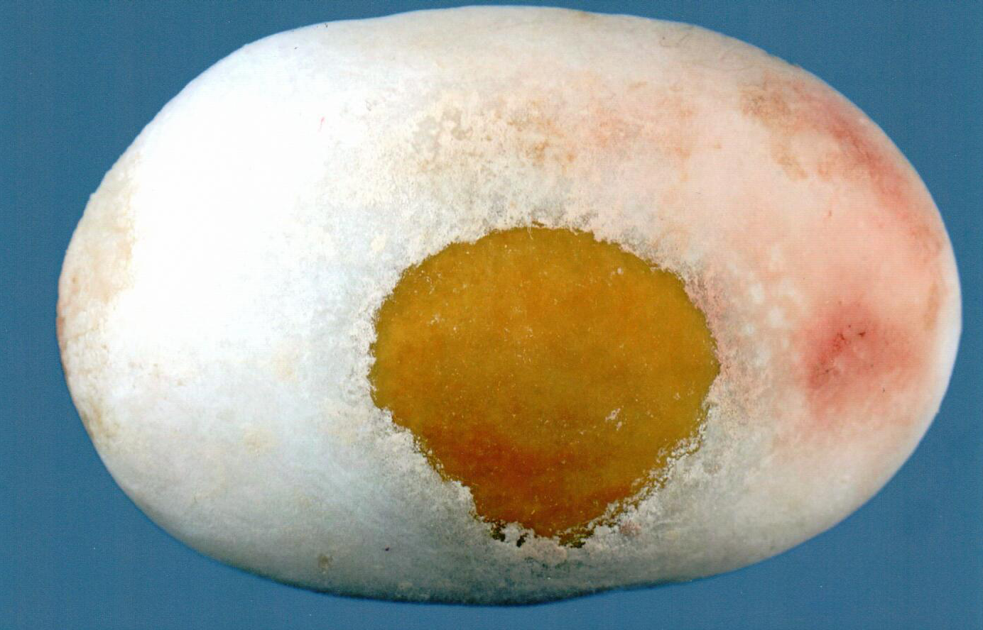 Technologists at our reference laboratory possess decades of experience in examining kidney stones. We have specialized in stone analysis for over 45 years.