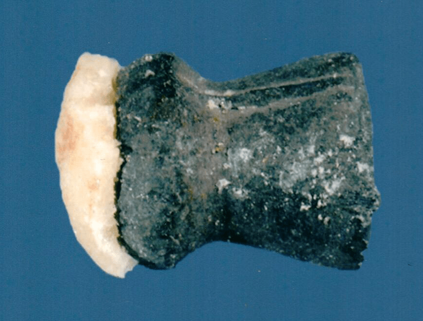 Technologists at our reference laboratory possess decades of experience in examining kidney stones. We have specialized in stone analysis for over 45 years.