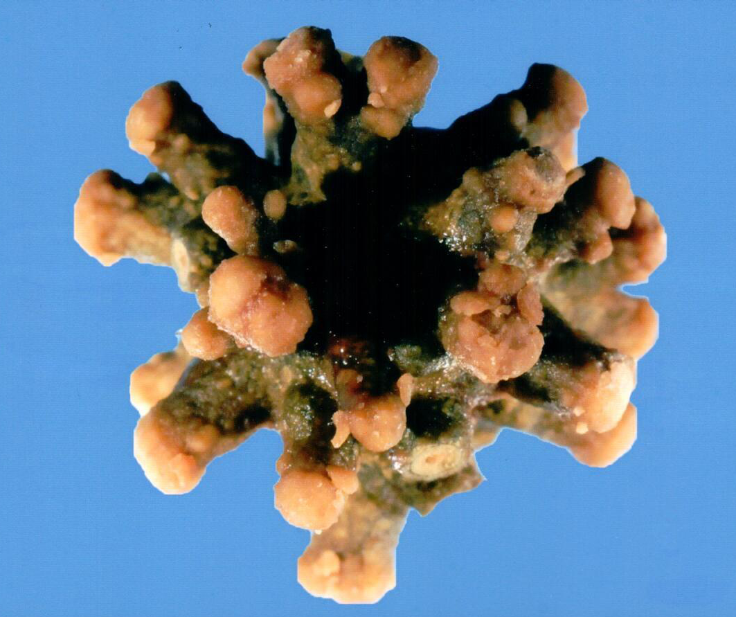 Technologists at our reference laboratory possess decades of experience in examining kidney stones. We have specialized in stone analysis for over 45 years.