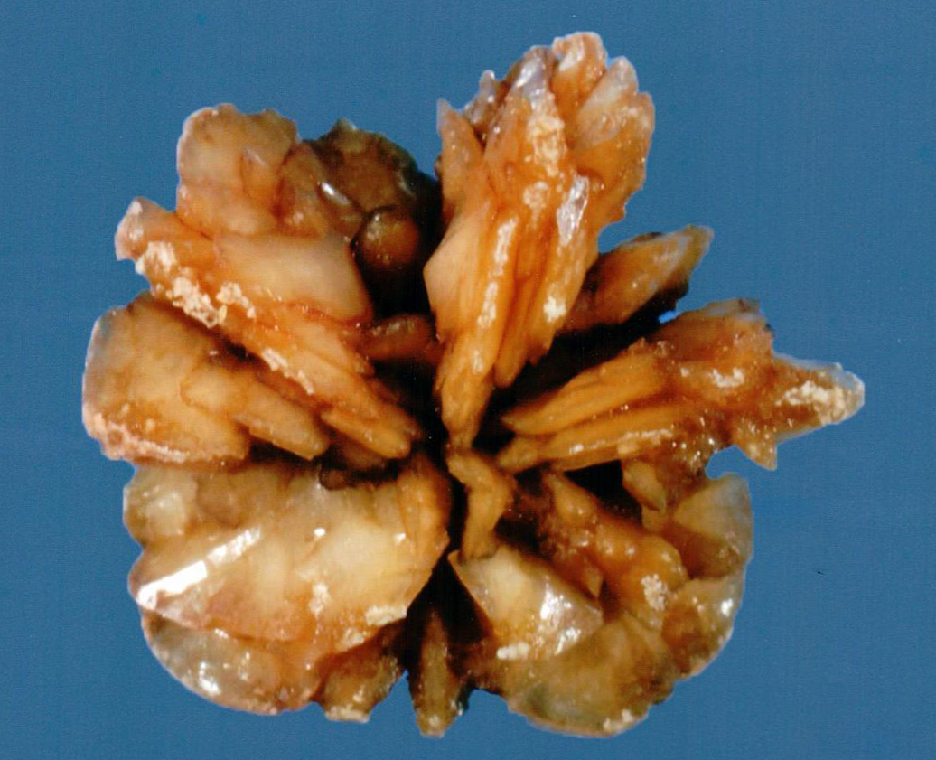 Technologists at our reference laboratory possess decades of experience in examining kidney stones. We have specialized in stone analysis for over 45 years.