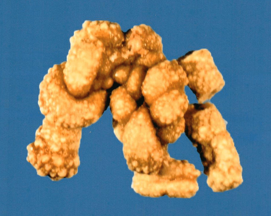 Technologists at our reference laboratory possess decades of experience in examining kidney stones. We have specialized in stone analysis for over 45 years.