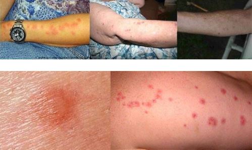 Photos of person with bed bug bites
