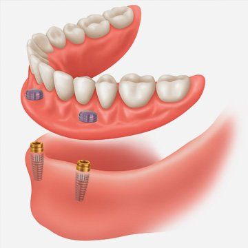 An illustration of a denture with two screws in it