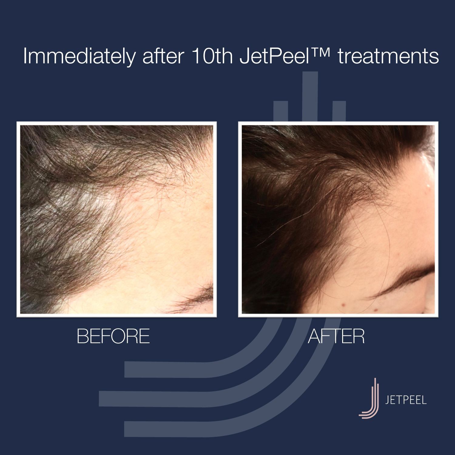 Ein Bild von den Haaren einer Frau vor und nach der Jetpeel-Behandlung