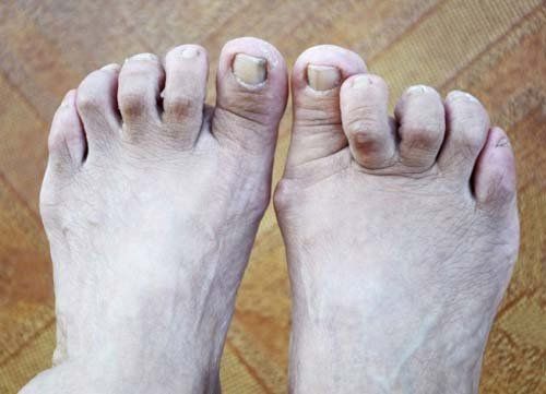 Unghie dei piedi incarnite