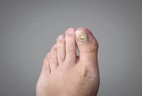 Cura unghie incarnite