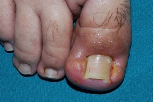 Casi di unghia incarnita