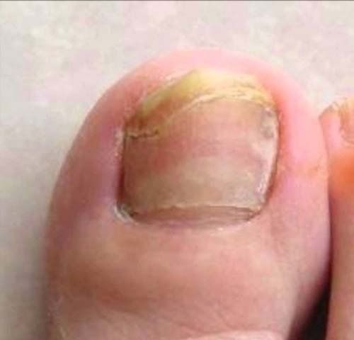 Alluce con unghia incarnita