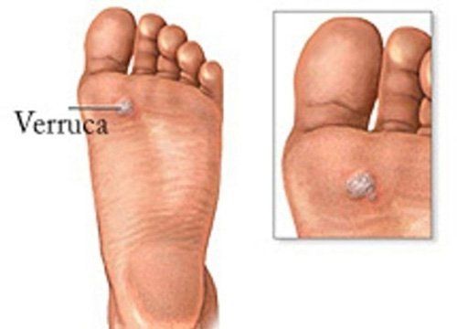 Verruche dei piedi
