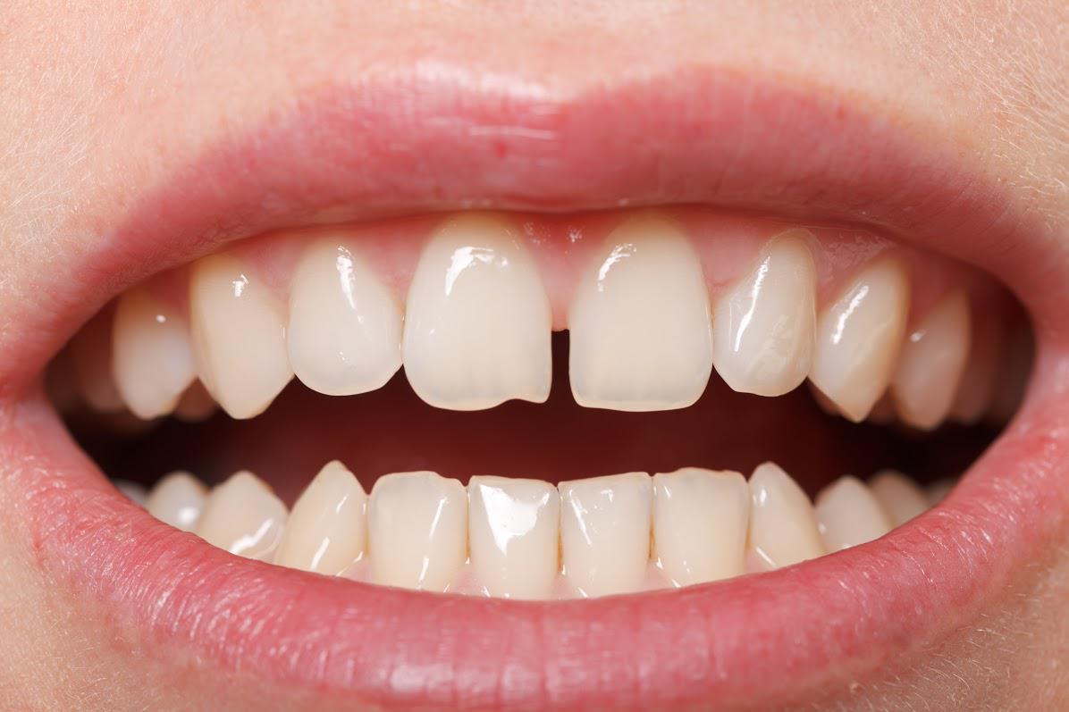 Teeth Gap — Sarasota, FL — Gregory S. Rutherford, DDS, PA