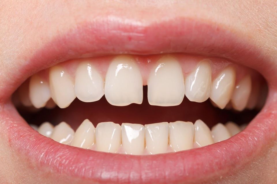 what-you-need-to-know-about-gaps-between-teeth