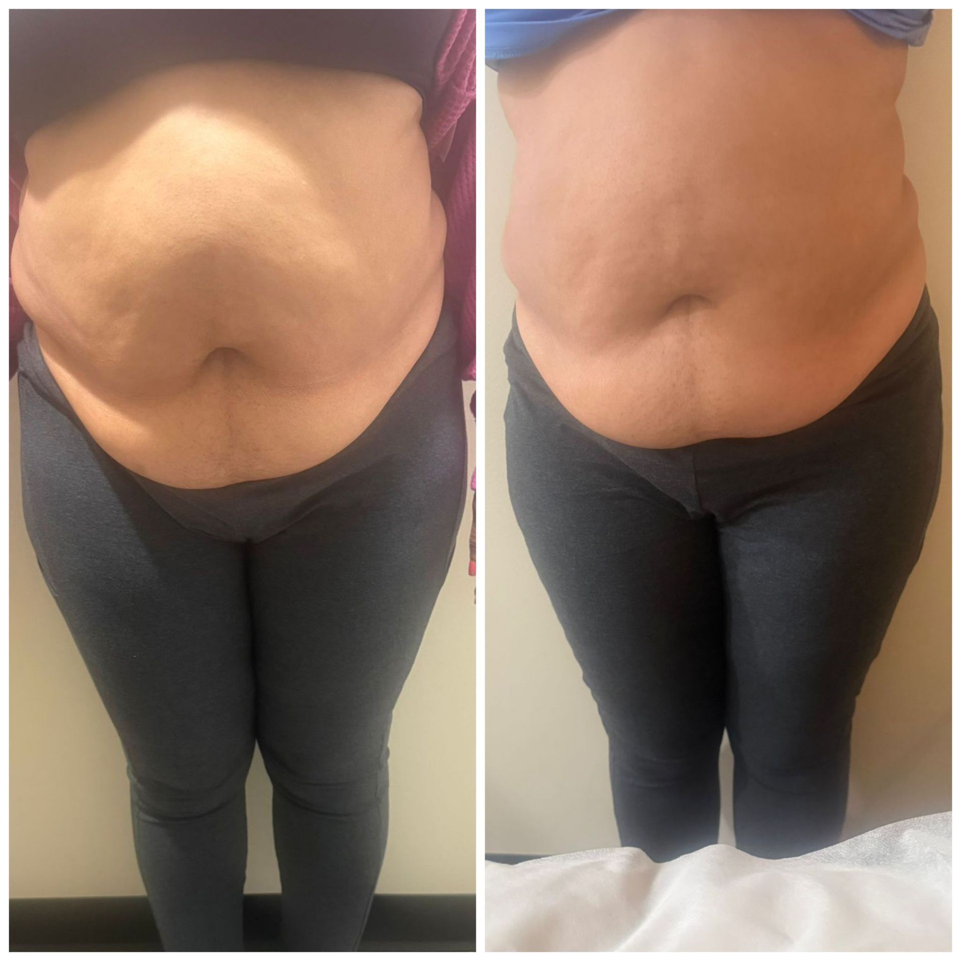 A before and after photo of a woman 's stomach