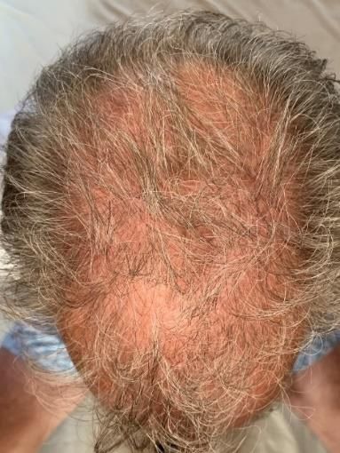 A close up of a man 's head with a bald spot on it
