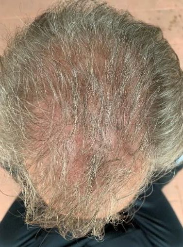 A man with gray hair and a beard is looking up at his head