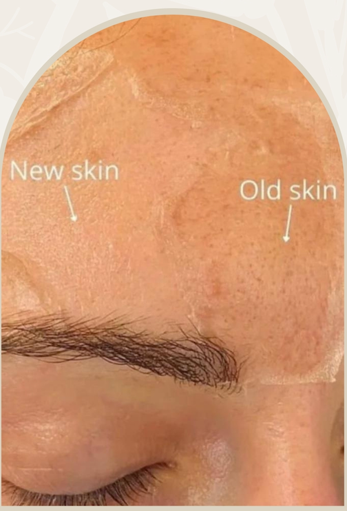 Light chemical peels