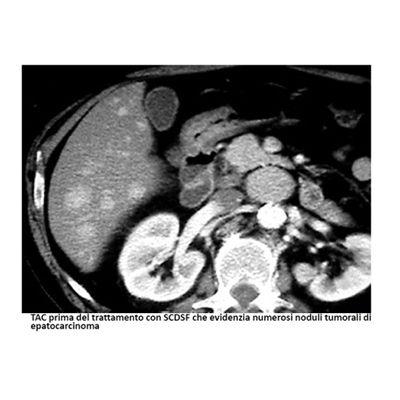 A black and white image of a liver and kidneys.