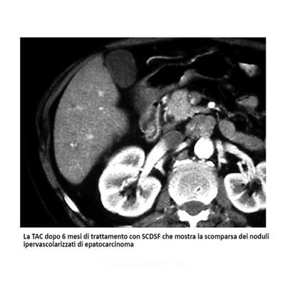 A black and white image of a liver and kidneys