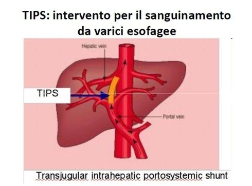A diagram of a liver with the words tips on it