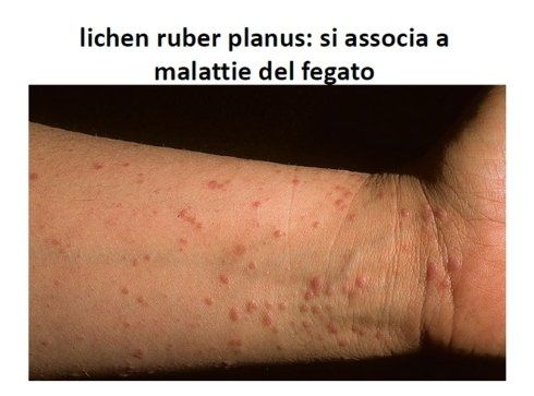 A close up of a person 's arm with red spots on it