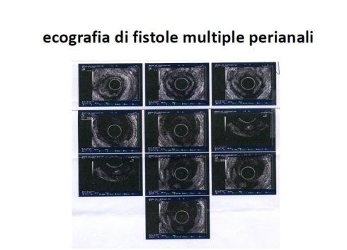 A bunch of black and white images with the words ecografia di fistole multiple perianali