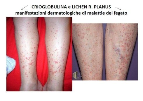 Two pictures of a person 's legs with the words crioglobulina e lichen r. planus