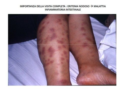 A picture of a person 's legs with purple spots on them