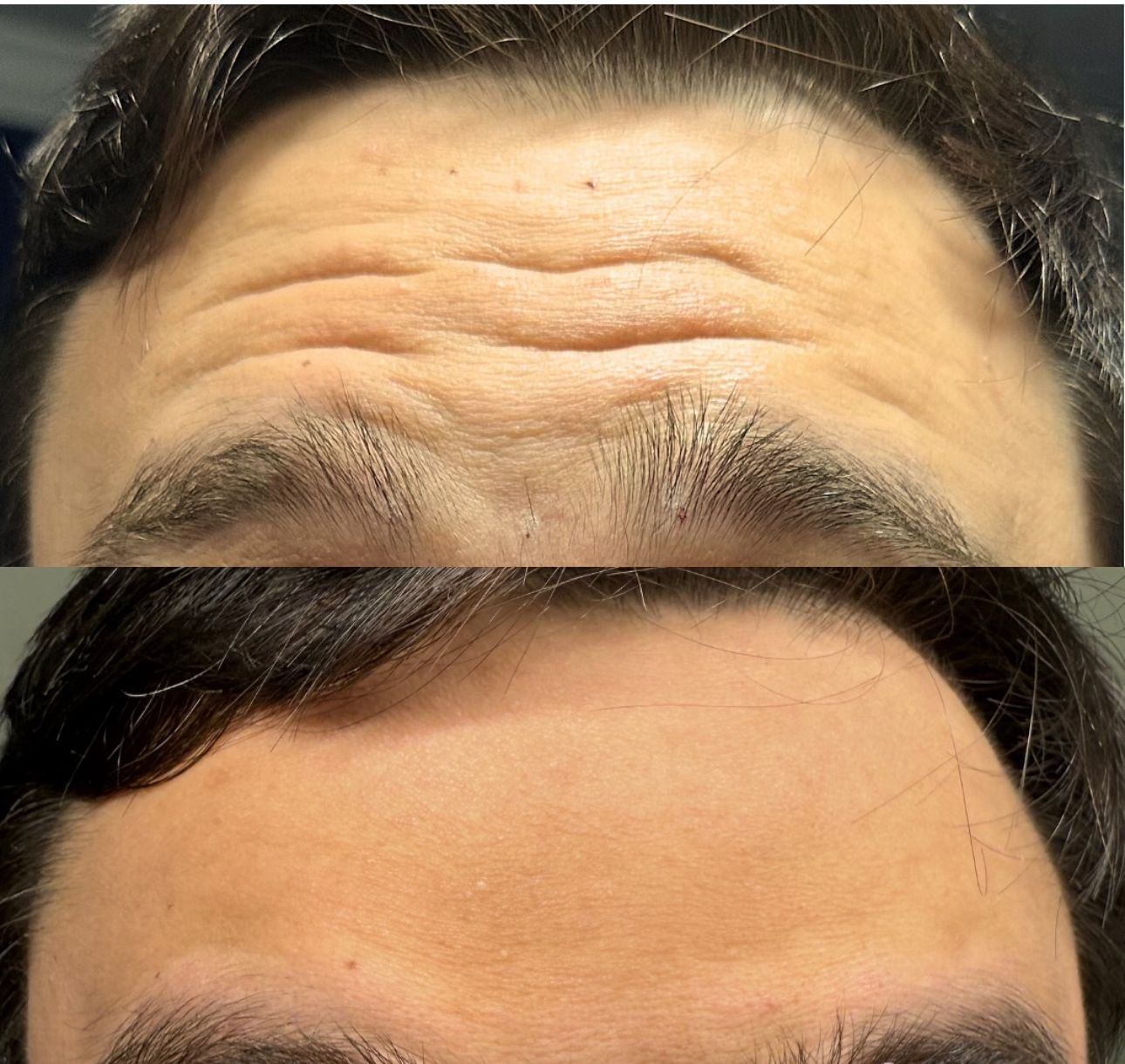 A before and after picture of a man 's forehead
