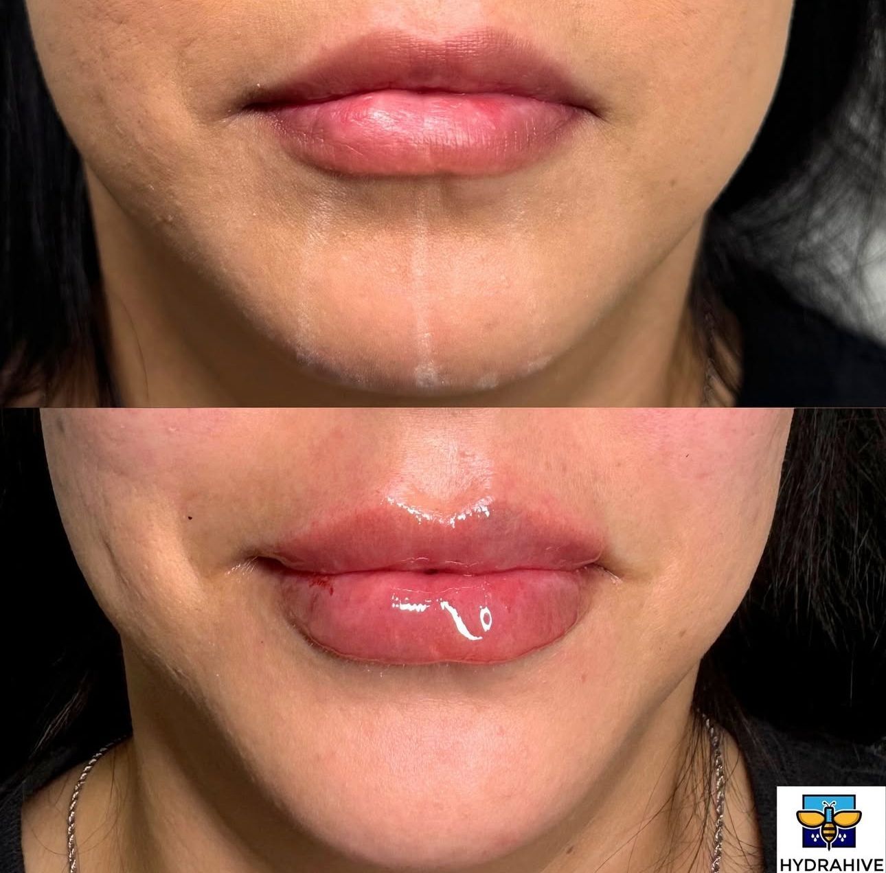 A before and after photo of a woman 's lips with the letters nyc visible