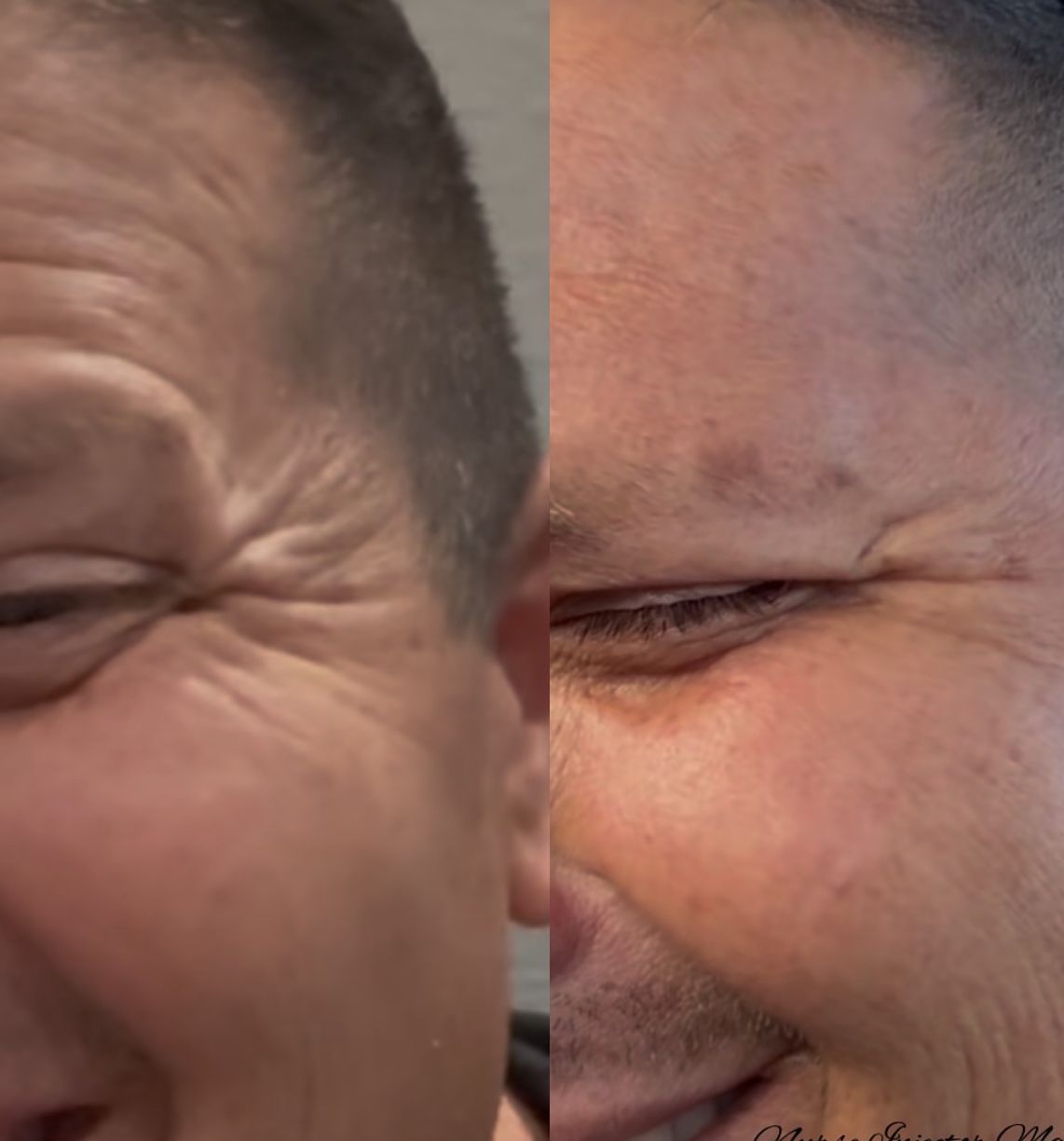 A before and after photo of a man 's face with wrinkles