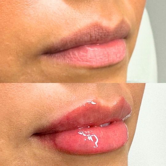 A before and after picture of a woman 's lips.