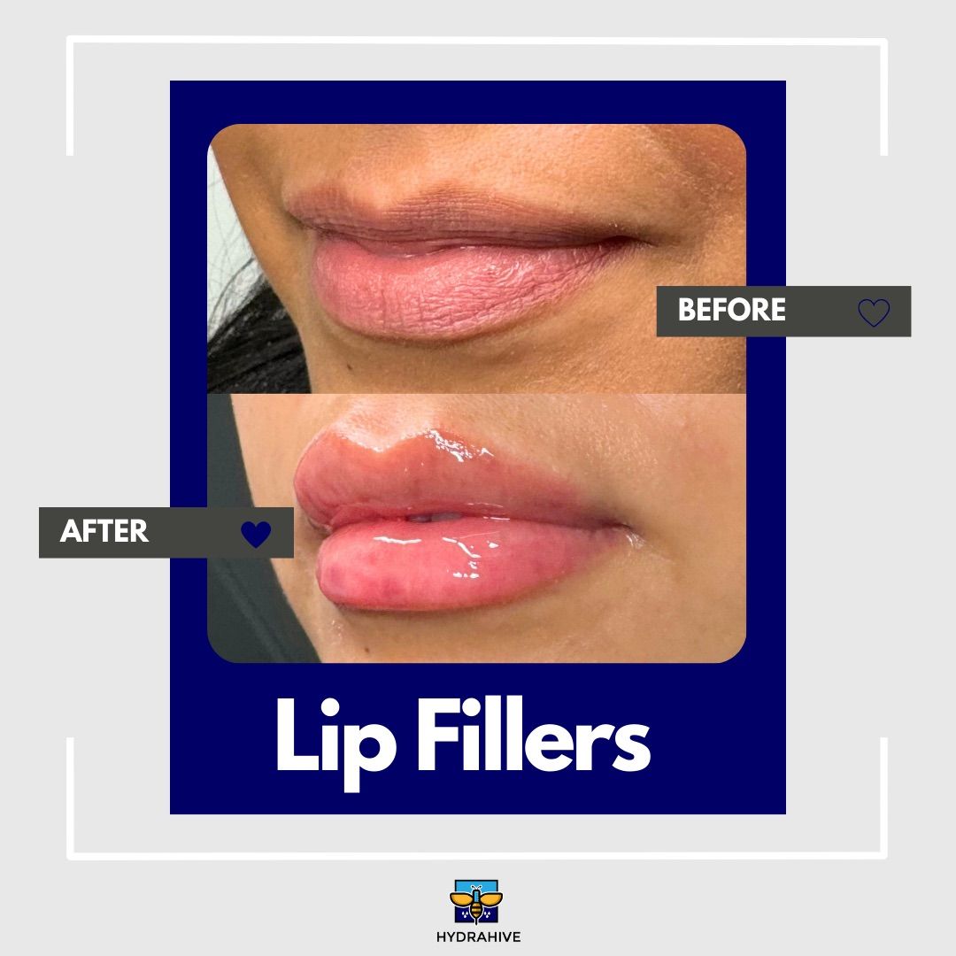 A before and after photo of a woman 's lips with lip fillers.