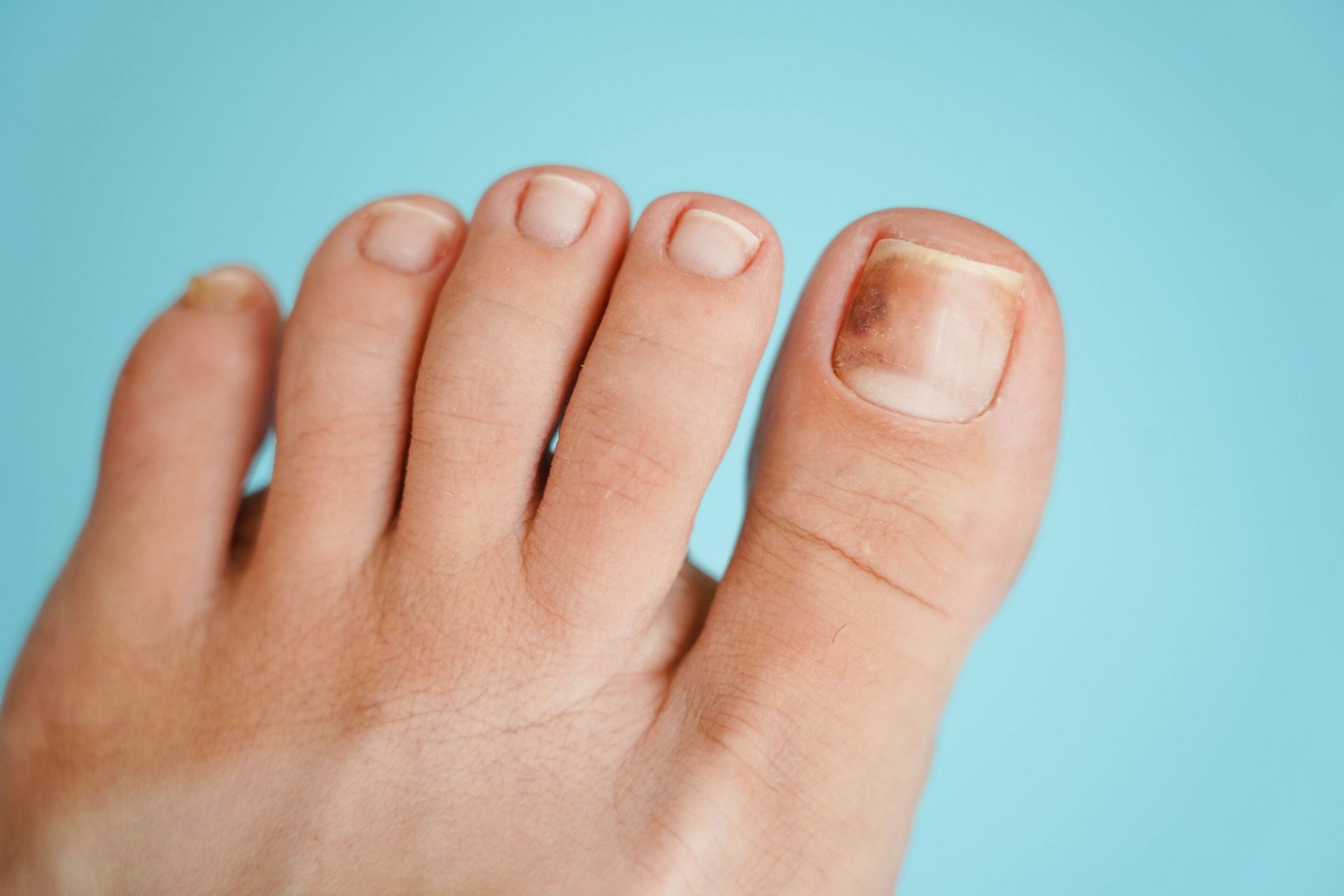 Foot with a toenail showing a dark, brown discoloration.